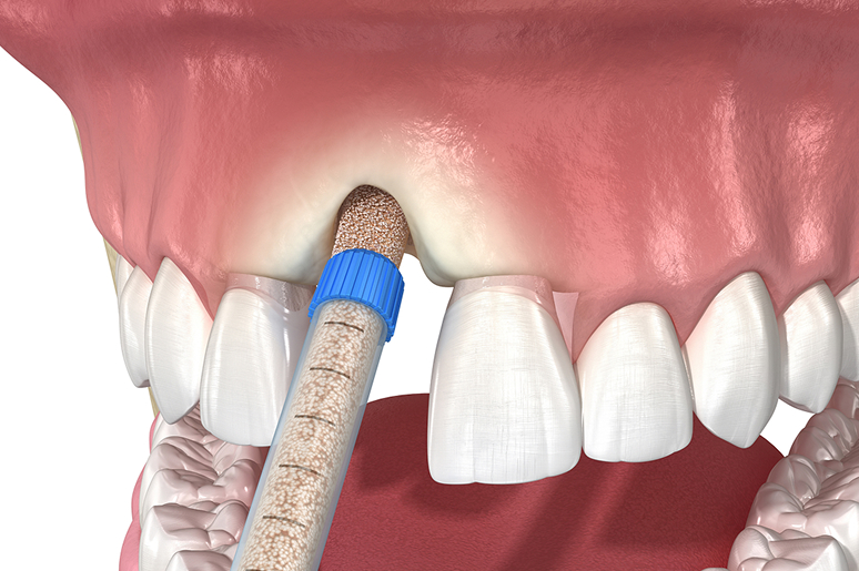 Bone grafting Bonita Springs FL