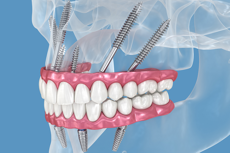 Zygomatic implants Bonita Springs FL